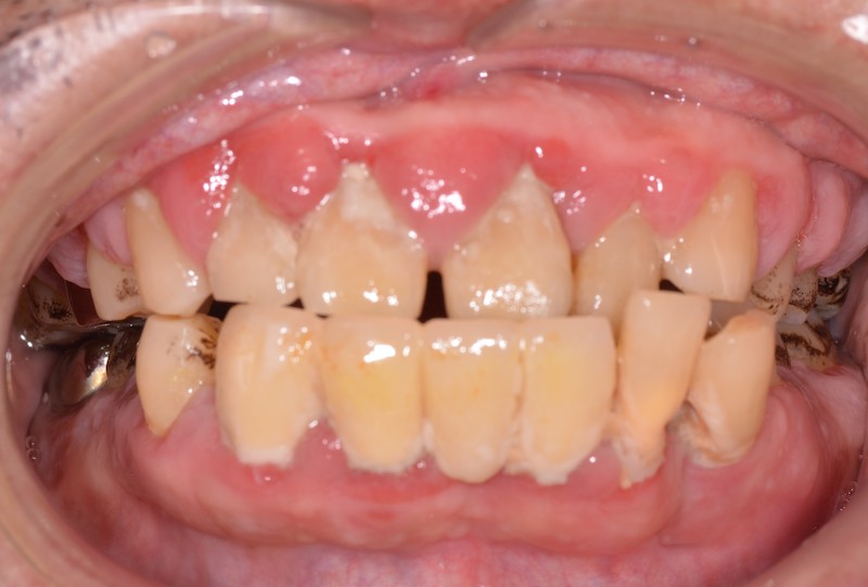 重度歯周炎の歯